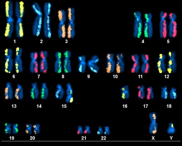 dGH SCREEN karyogram of a triple-edited T cell displaying multiple inversions and a dicentric derivative composed of material from chromosomes 15 and 16.